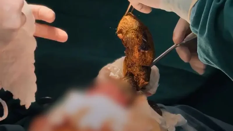 No Acre, criança faz cirurgia para retirar cabelo do estômago e intestino