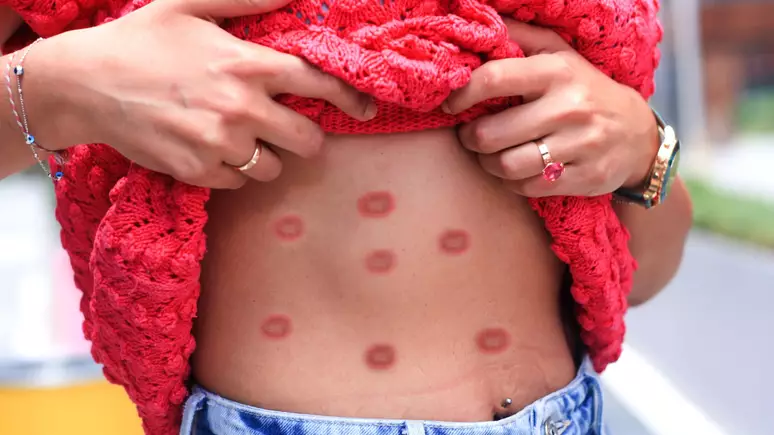 🚨 Acre confirma primeiro caso de Mpox no interior e autoridades iniciam rastreamento