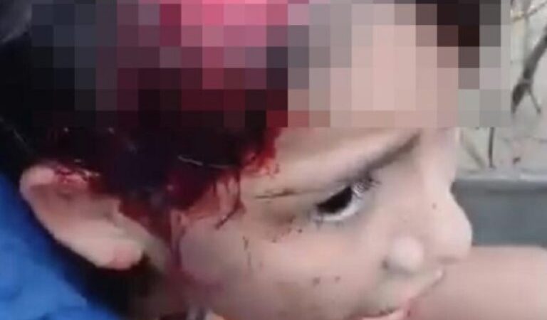 🚨 Menina de 11 anos tem couro cabeludo arrancado por motor de embarcação no interior do Acre