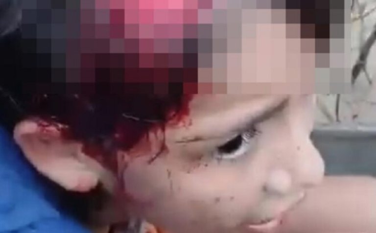 🚨 Menina de 11 anos tem couro cabeludo arrancado por motor de embarcação no interior do Acre